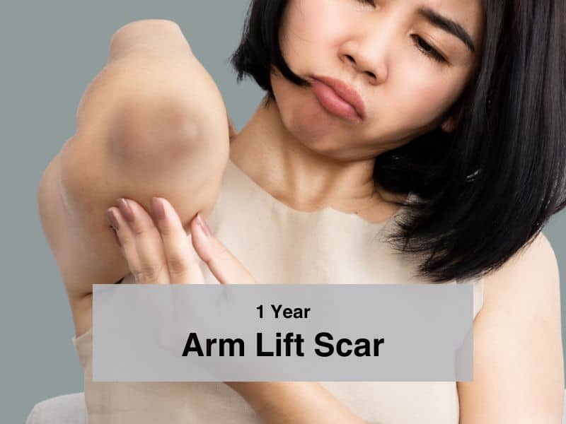 1 Year Arm Lift Scar