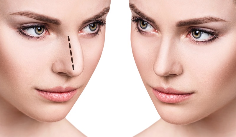 Types of Rhinoplasty