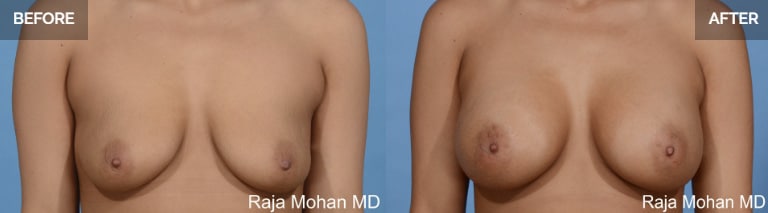 Breast Enlargement Dallas