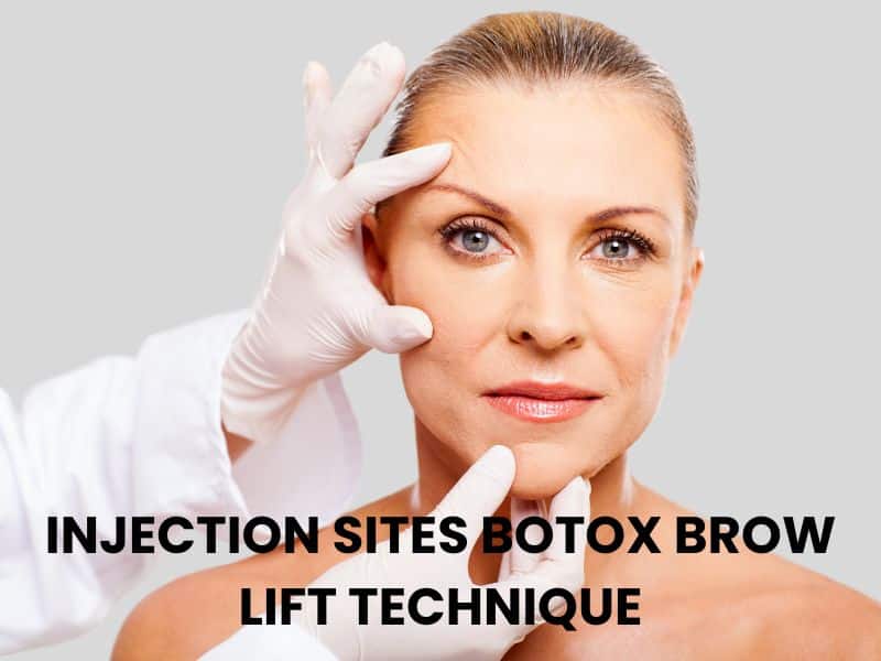 injection sites botox brow lift technique