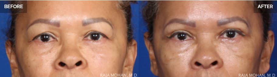 Dallas Blepharoplasty