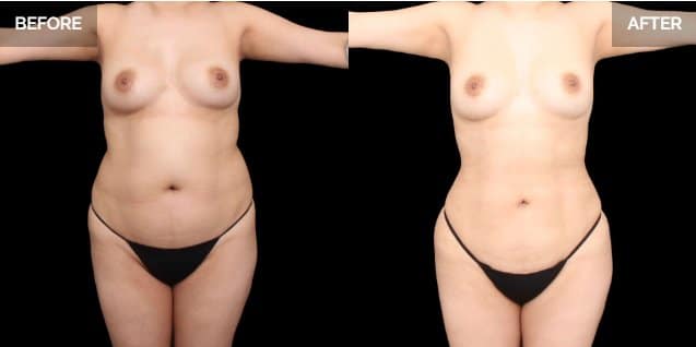 Dallas Liposuction