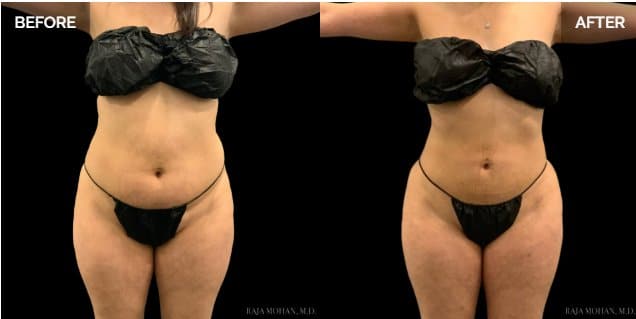 Dallas Liposuction