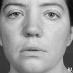 Rhinoplasty Dallas