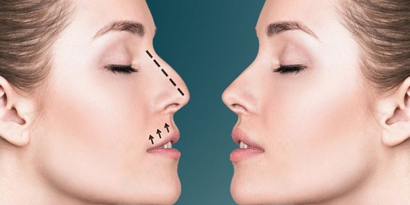 15 Most Popular Reasons for Rhinoplasty