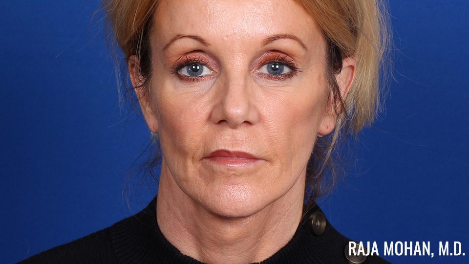 Facelift 2