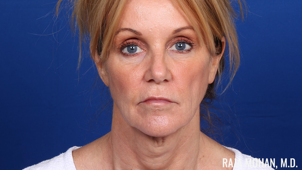 Facelift 1
