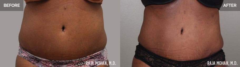 360 Liposuction Before and After Addison