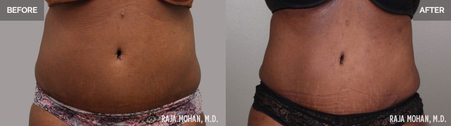 360 Liposuction Before and After Aledo