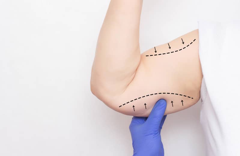 Arm Liposuction Scars