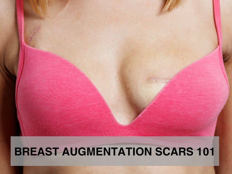 Breast Augmentation Scars 101