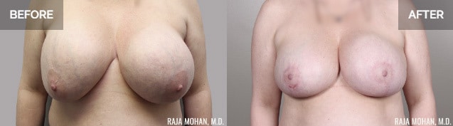 Breast Implant Revision Recovery Dallas