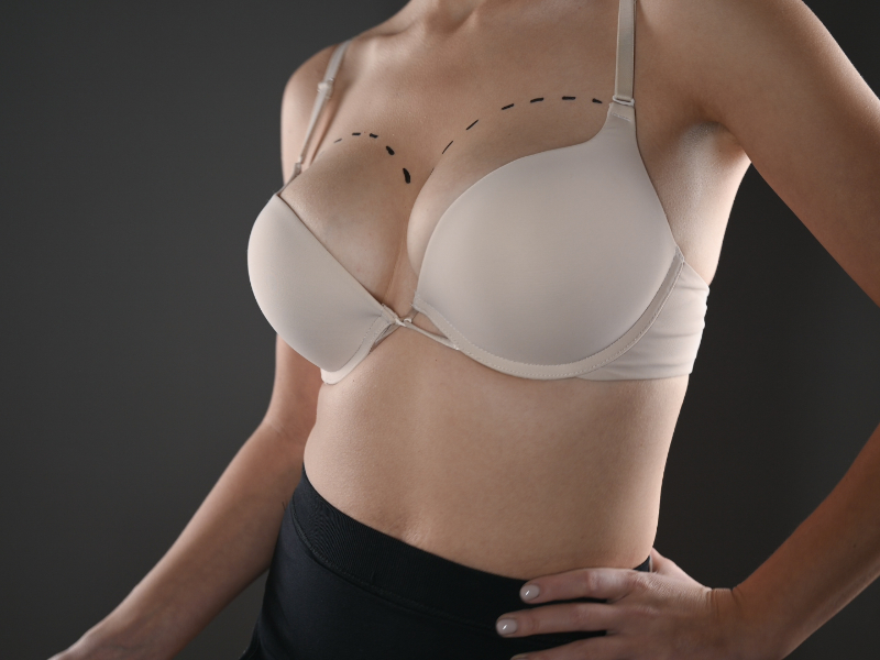 Breast Lift Before And After What To Expect