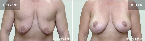 Breast Lift Before and Afer Dallas