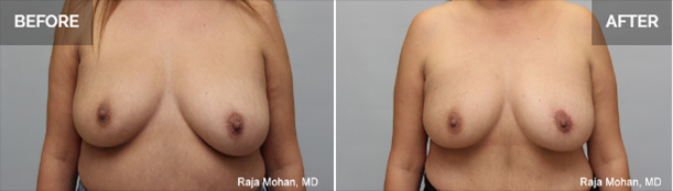Breast Lift Dallas Recovery
