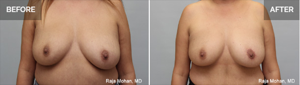 Breast Lift Dallas Recovery