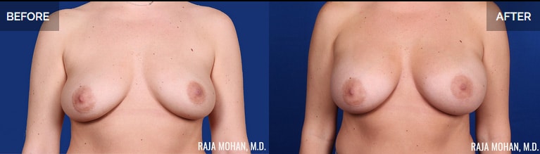 Breast augmentation Dallas