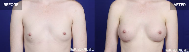 Breast augmentation in dallas