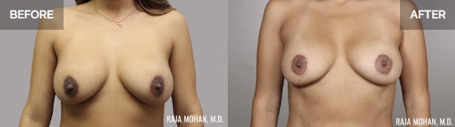 Breast Implant Revision Before and After Dallas
