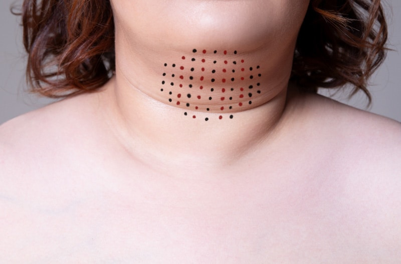 Chin liposuction scar