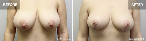Dallas Breast Lift Before and After
