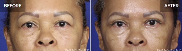 Dallas Eyelid Surgery