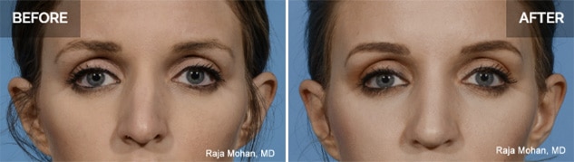 Dallas Rhinoplasty