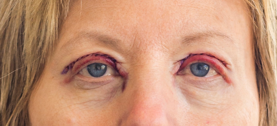 Day By Day Eyelid Surgery Recovery Time Photos