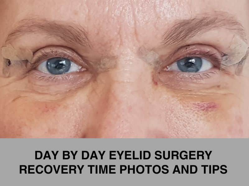 Day by Day Eyelid Surgery Recovery Time Photos and Tips