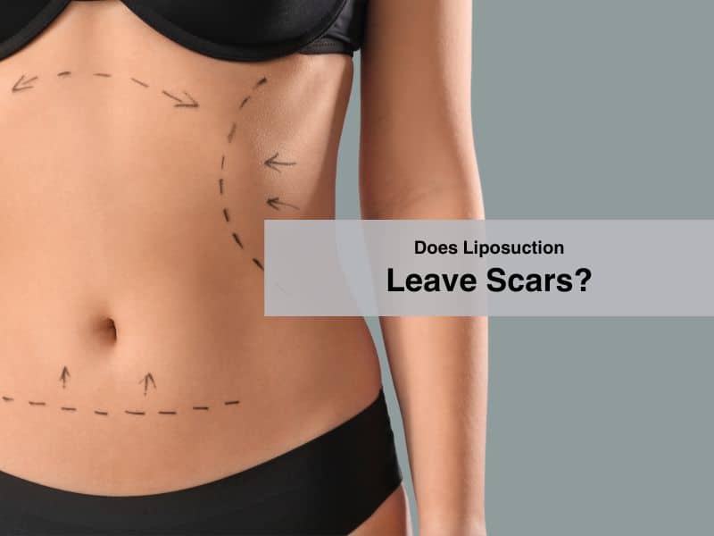 Does Liposuction Leave Scars
