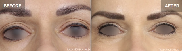 Droopy Eyelid Surgery Before and After