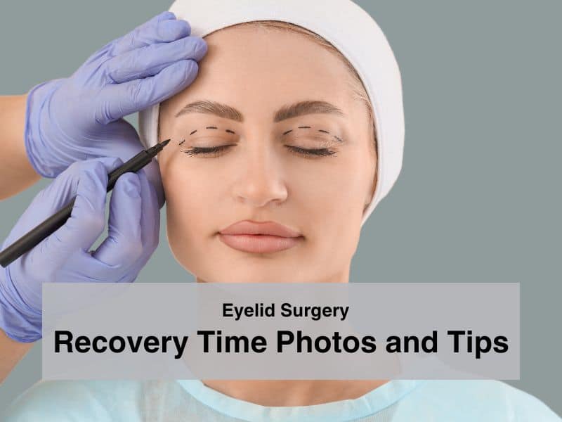 Eyelid Surgery Recovery Time Photos and Tips