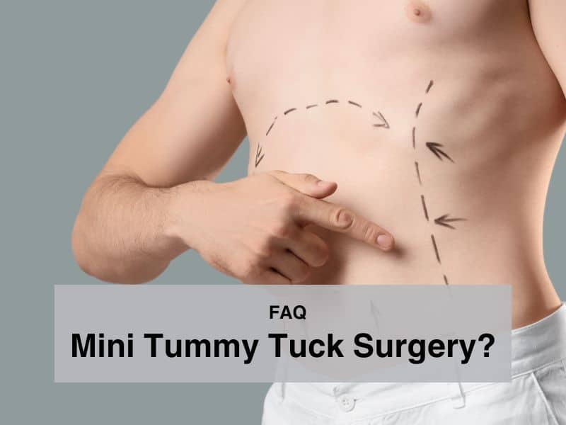 FAQ_ Mini Tummy Tuck Surgery