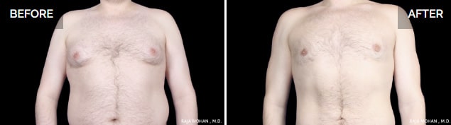 Gynecomastia vs chest fat pictures