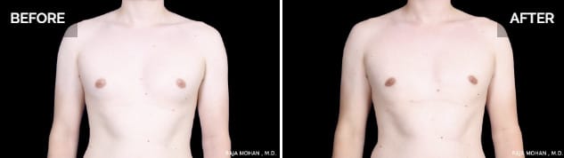 Gynecomastia vs fat pictures