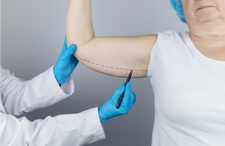 Healed arm liposuction scars