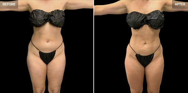 High Definition Lipo Dallas