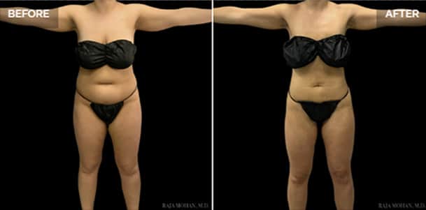 Liposuction in Dallas