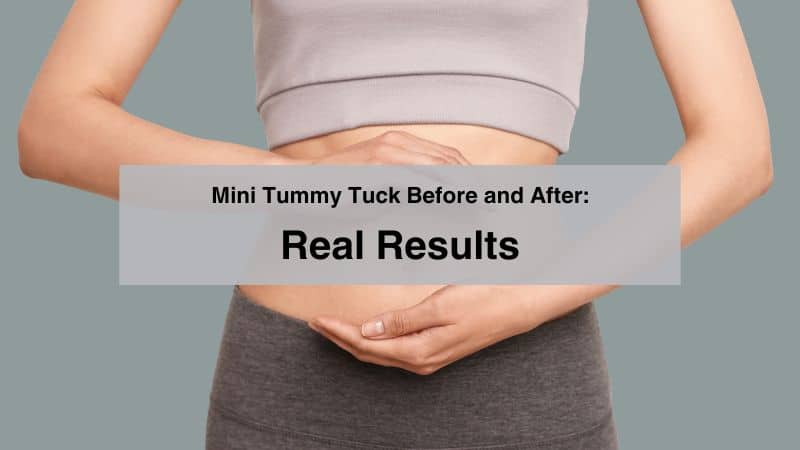 Mini Tummy Tuck Before and After- Real Results