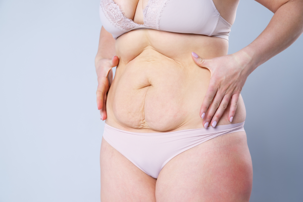 Mini Tummy Tuck Cost