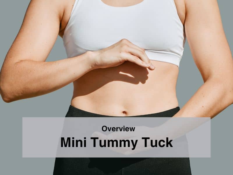 Mini Tummy Tuck Overview