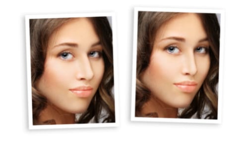 Nonsurgical rhinoplasty