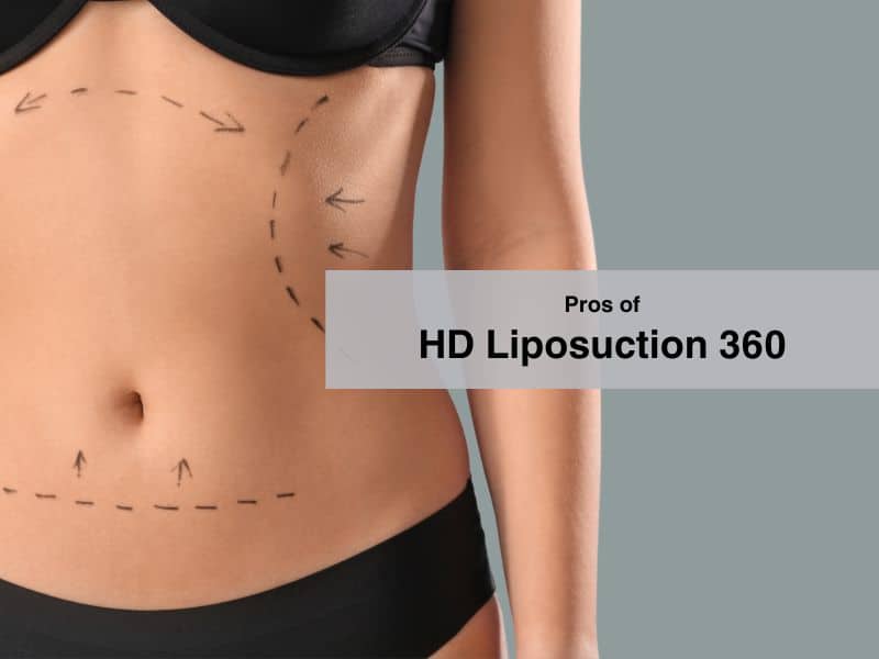 Pros of HD Liposuction 360