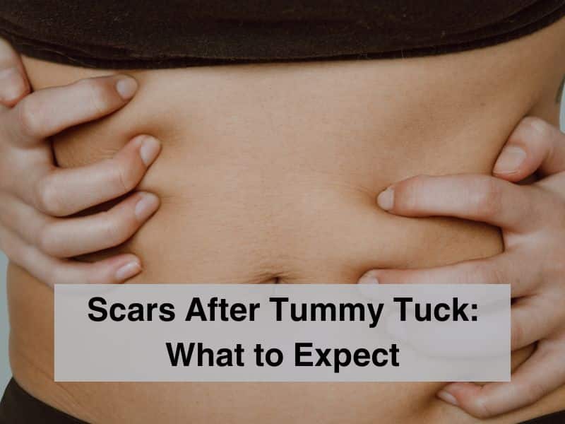 Scars After Tummy Tuck_ What to Expect