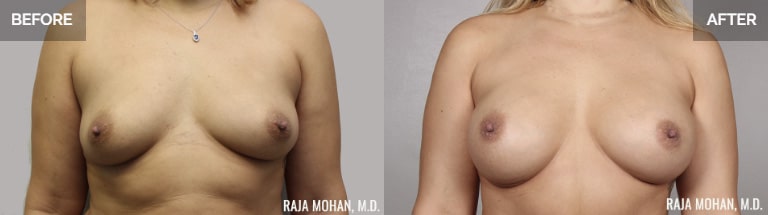 Silicone Breast Implants Dallas