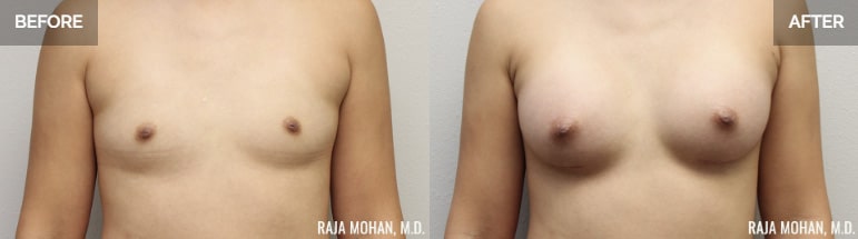 Silicone Breast Implants in Dallas
