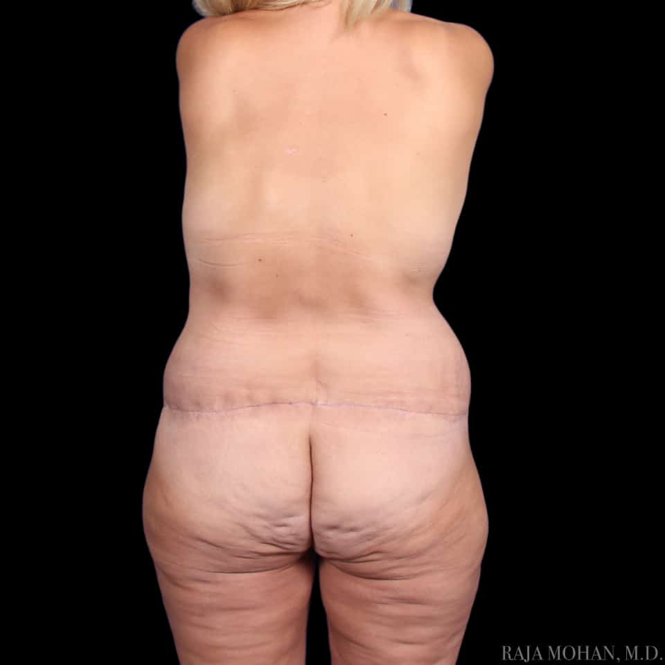 Reverse Upper Modified Lower Abdominoplasty Photo Gallery