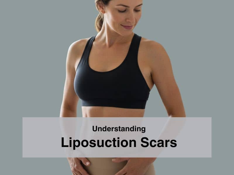 Understanding Liposuction Scars