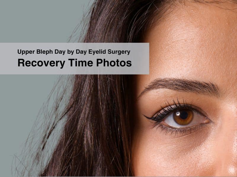 Upper Bleph Day by Day Eyelid Surgery Recovery Time Photos