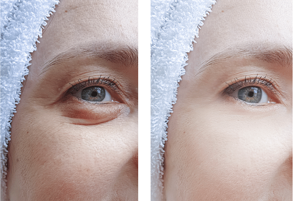 Upper Day By Day Eyelid Surgery Recovery Time Photos